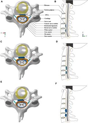 Effects of cervical rotatory manipulation on the cervical spinal cord complex with ossification of the posterior longitudinal ligament in the vertebral canal: A finite element study